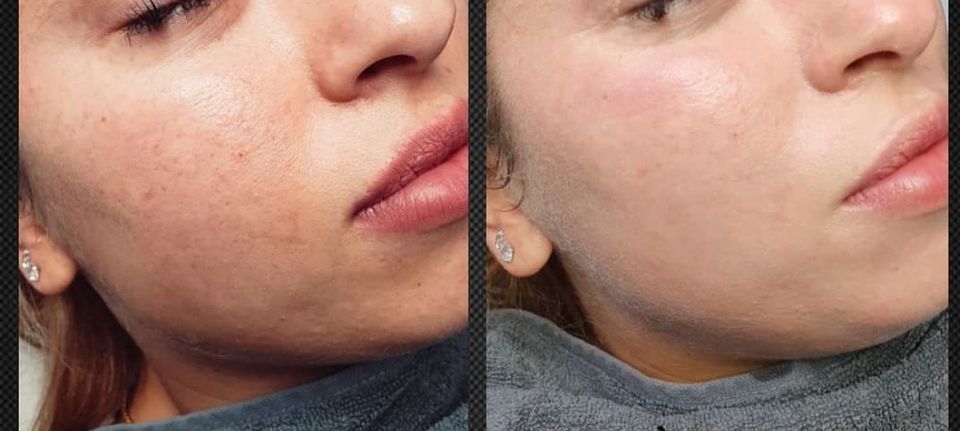 Professionelle Microneedling / BB-Glow Kombi Schulung in Flörsheim am Main