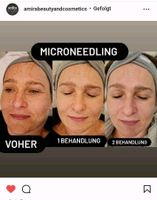 ❗Microneedling + BB-Glow ❗Schulung + Zertifikat + Starter Set Nordrhein-Westfalen - Moers Vorschau