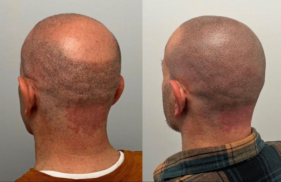 Haarpigmentierung Hair Tattoo in Rosenheim SMP Scalp Micro Pigmentation Haartätowierung Haar Pigmentierung Rosenheim in Rosenheim