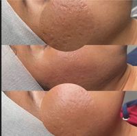 Microneedling Nordrhein-Westfalen - Gelsenkirchen Vorschau