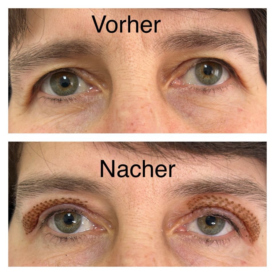 Plasma Pen Face Lifting - Gesichtsstraffung ohne OP in Aulendorf