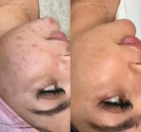 Microneedling neue straffe Haut Niedersachsen - Hildesheim Vorschau