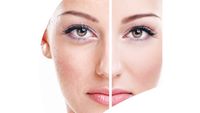 Mikroneedling Akne Pigmentflecken Anti Aging Microneedling Hessen - Groß-Gerau Vorschau