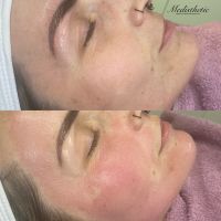 Microneedling Baden-Württemberg - Karlsruhe Vorschau