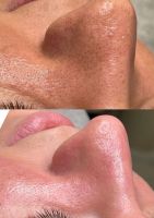 Hydrafacial / Microneedling Nordrhein-Westfalen - Ratingen Vorschau