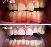Zahnbleaching kosmetische Zahnaufhellung Nordrhein-Westfalen - Datteln Vorschau