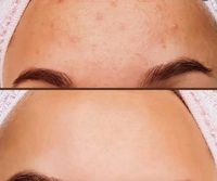 Aqua Facial, Microneedling, Microdermabrasion Niedersachsen - Duingen Vorschau