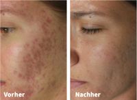 Microneedling - Hausbesuche möglich Nordrhein-Westfalen - Hagen Vorschau