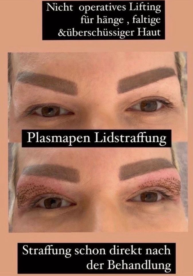 Plasmapen Schulung in Essen