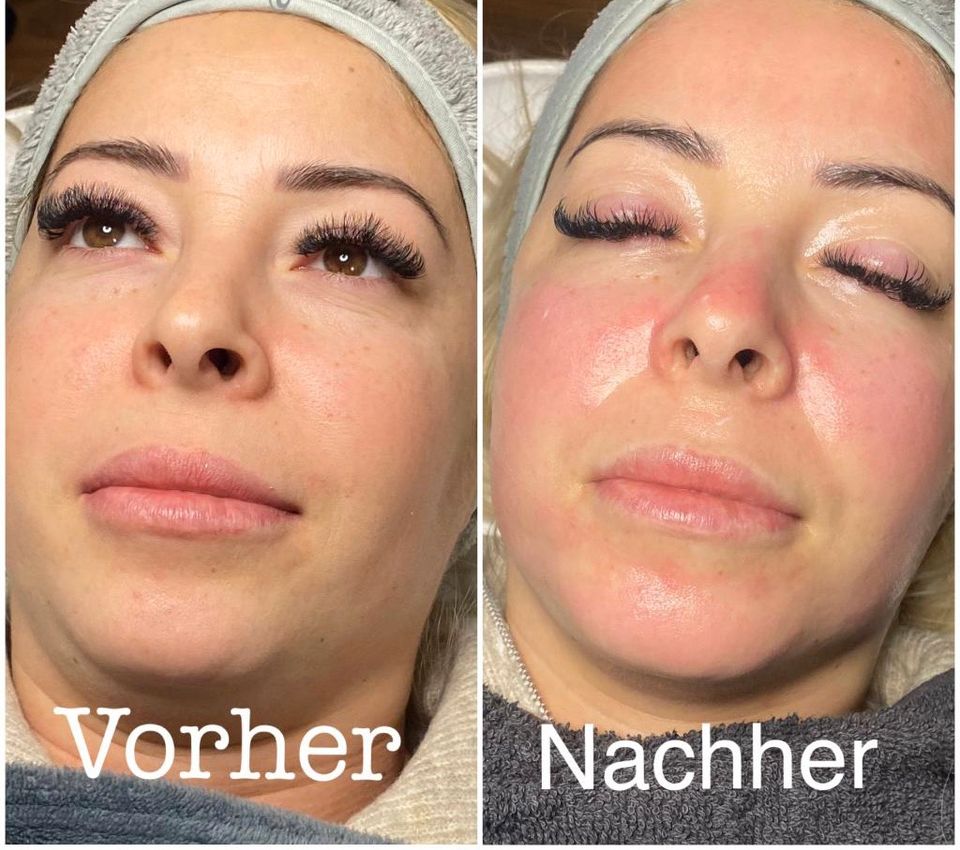 Dampfer+hydrafacial+microneedling+Bbglow+lichttherapie 5 in 1 in Berlin