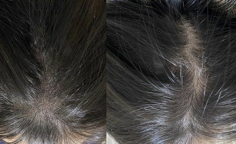 Kopfhautpigmentierung -Scalp -Haarneedling Schulung in Bad Vilbel