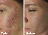 Modelle für Microneedling Nordrhein-Westfalen - Meerbusch Vorschau