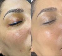 Bb glow Microneedling Nordrhein-Westfalen - Bottrop Vorschau