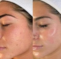 Bb glow microneedling Rheinland-Pfalz - Ludwigshafen Vorschau