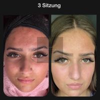 Microneedling/ BB Glow Hausbesuche möglich uvm. Wandsbek - Hamburg Sasel Vorschau