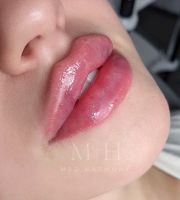 Russian Lips, Lippenunterspritzung, Lemon Bottle, Doppelkinn usw Stuttgart - Stuttgart-West Vorschau