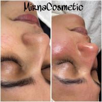 Aquafacial, Microneedling BB Glow Gesichtsbehandlungen Düsseldorf - Mörsenbroich Vorschau