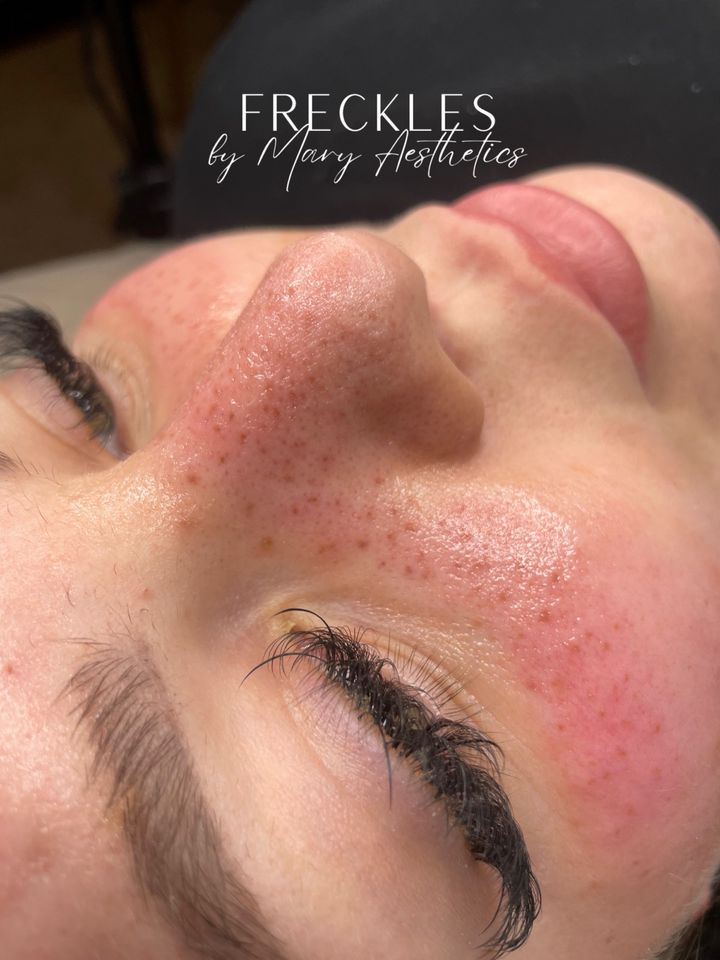 Fake Freckles Sommersprossen Pigmentierung Permanent Make up pmu in Herne