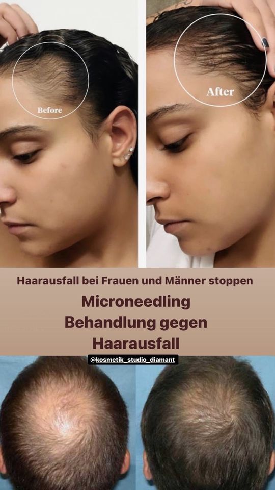 Microneedling gegen Haarausfall in Berlin