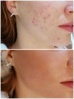 Bb- Glow Microneedling  Bb-lips Nordrhein-Westfalen - Oberhausen Vorschau