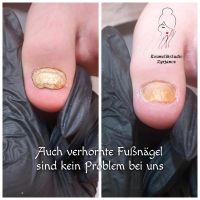 Problem Fußnägel Hessen - Viernheim Vorschau