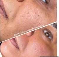 Microneedling, BB-Glow, Haarwuchsanregung Nordrhein-Westfalen - Moers Vorschau