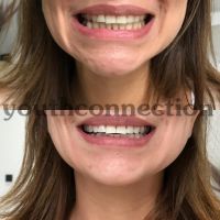 Schonende Zahnaufhellung, kosmeti. Zahnbleaching ohne Schmerzen Hannover - Mitte Vorschau