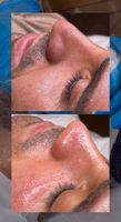 Microneedling Dortmund - Barop Vorschau