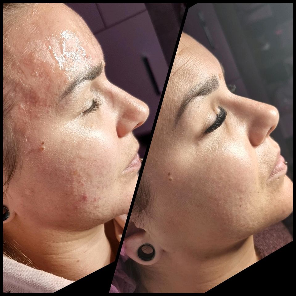 2 in1 Schulung BB Glow + Microneedling in Wadern
