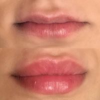 Hyaluron Pen Lippen Vergrößerung 95 € Berlin - Neukölln Vorschau