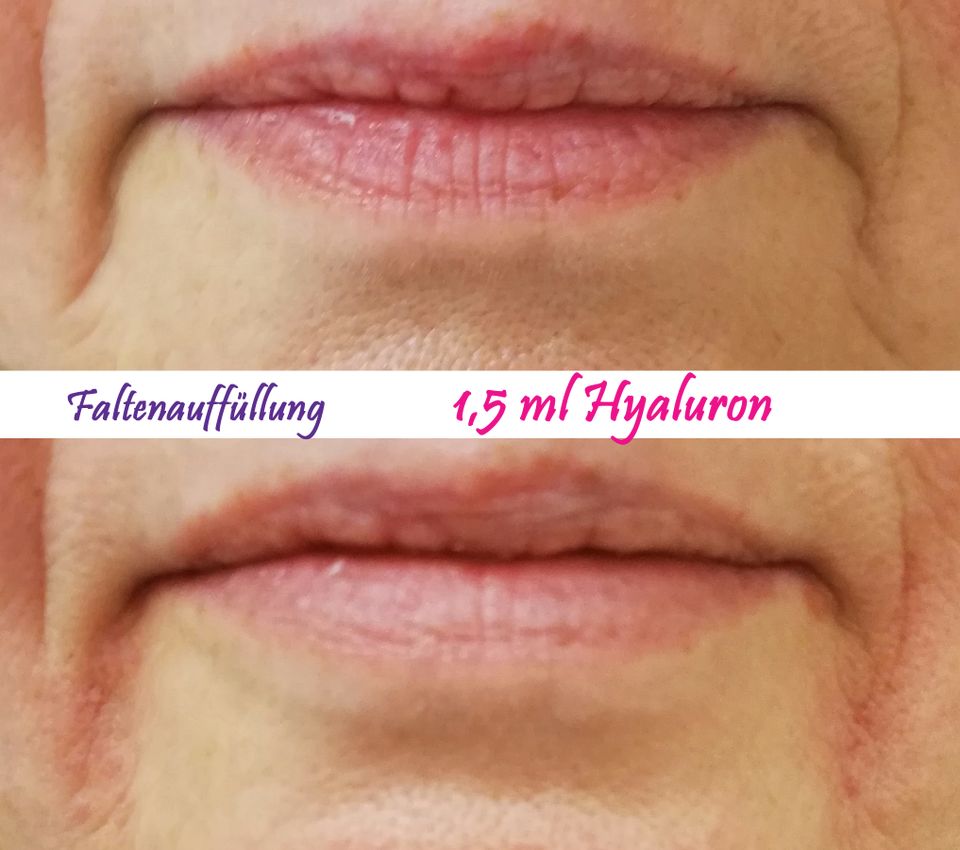 HYALURON - Aufpolsterung - 1 ml / Lippen - Nase - Falten in Paderborn